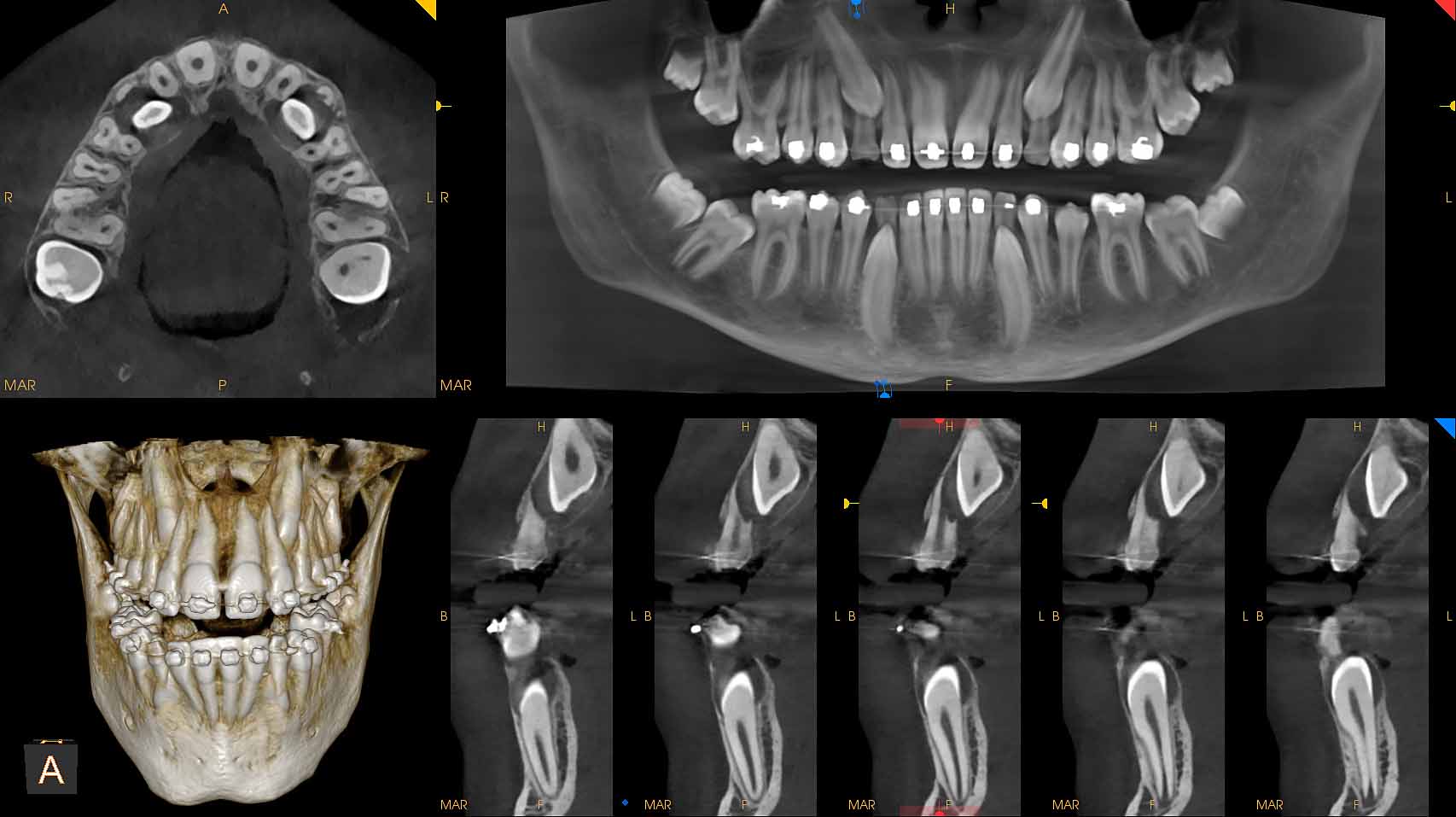 CBCT image of impacted canines